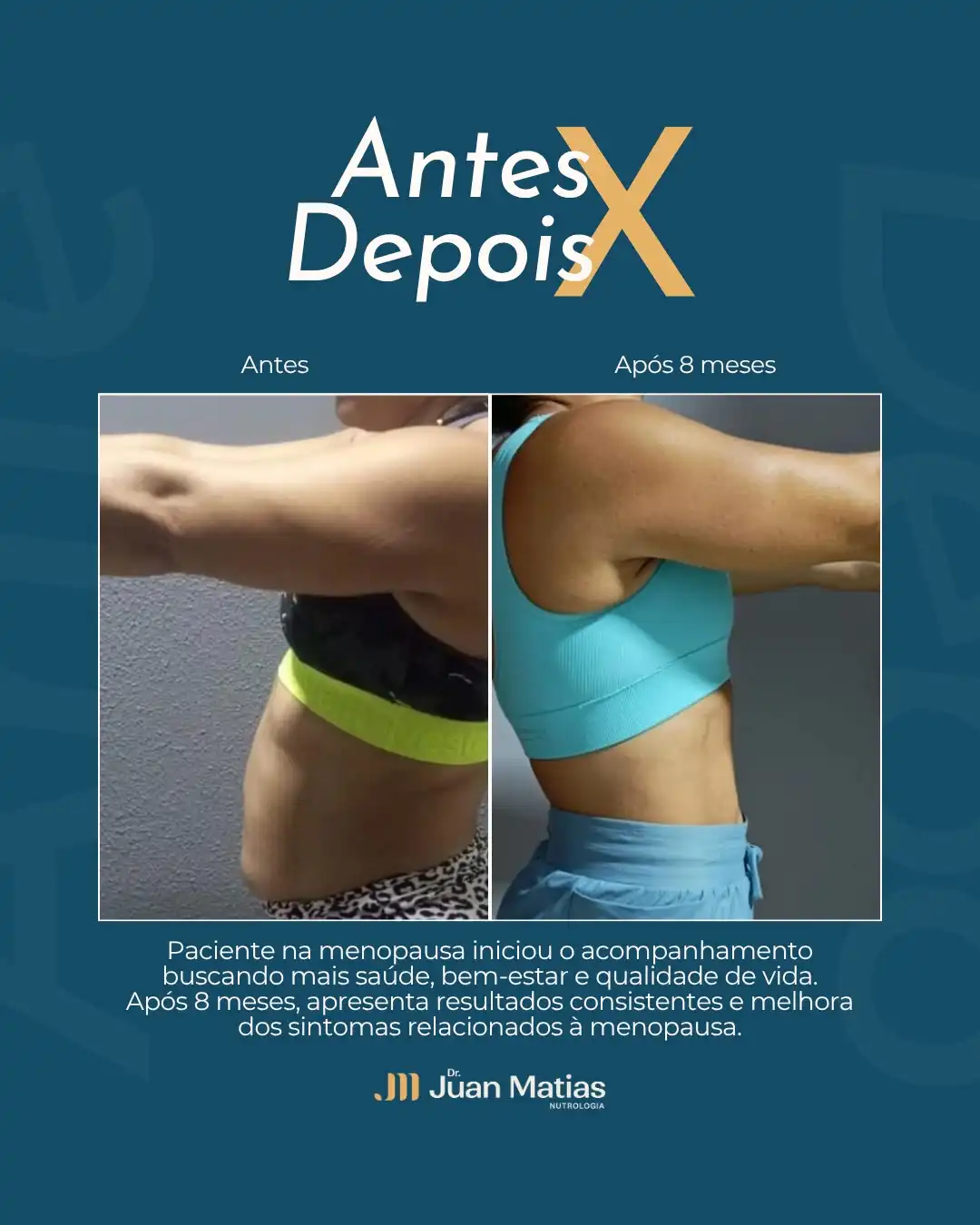 Antes e depois de emagrecimento feminino após 4 meses de acompanhamento individualizado em Brasília