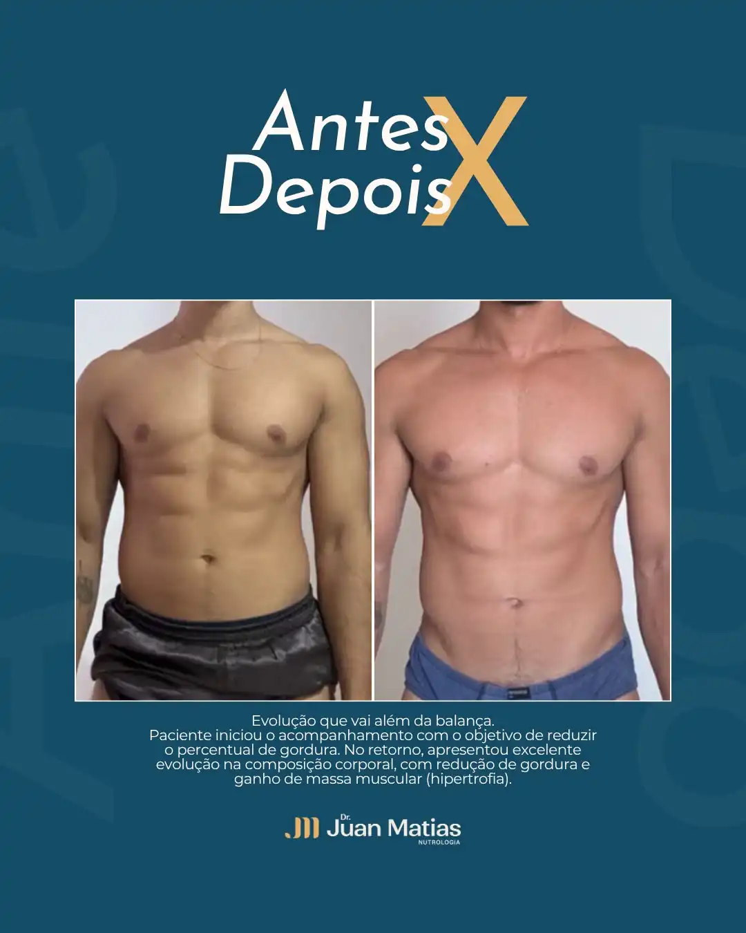 Antes e depois de redução de gordura e ganho de massa muscular com acompanhamento nutrológico em Brasília