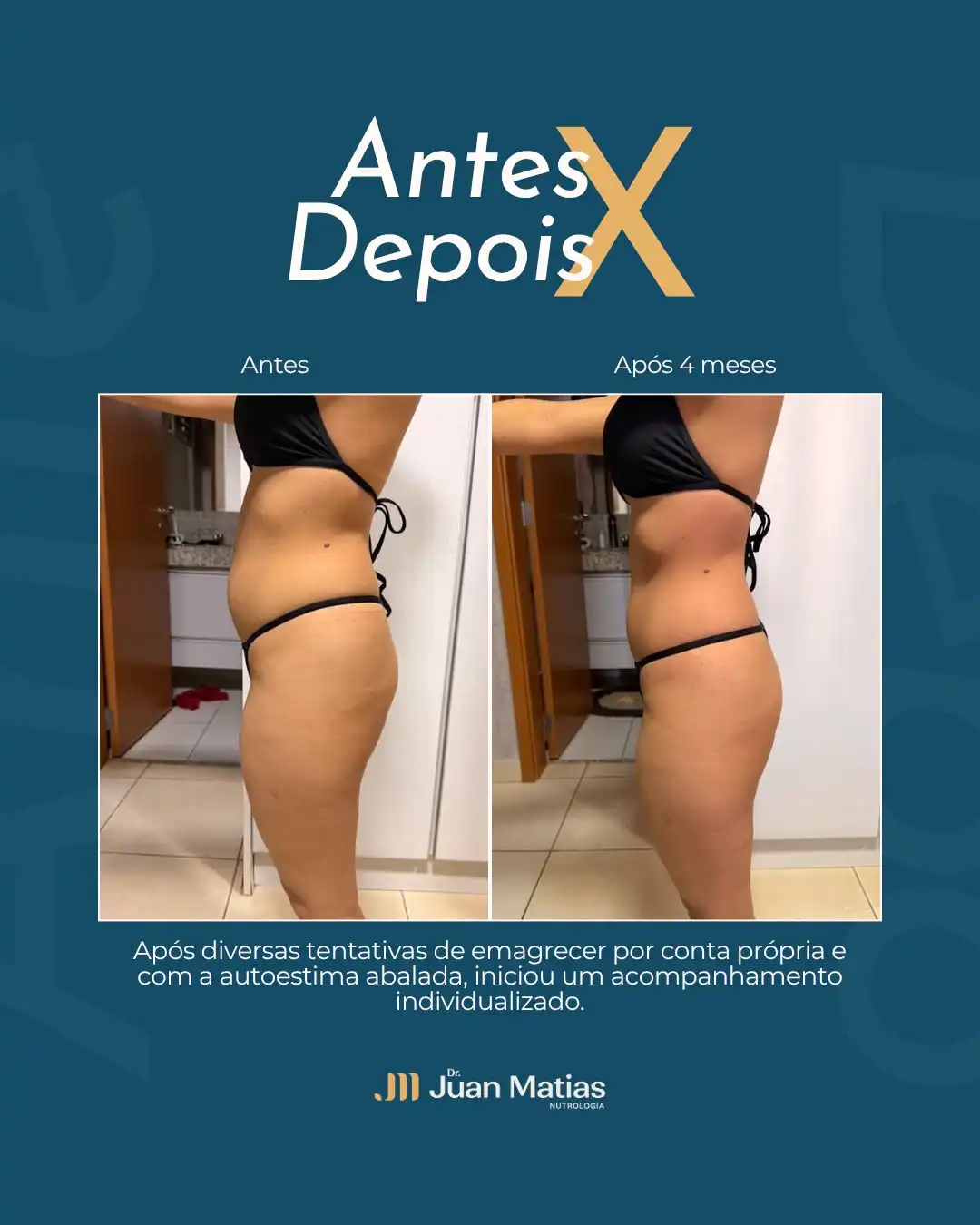 Antes e depois de redução de gordura e ganho de massa muscular com nutrologia em Brasília