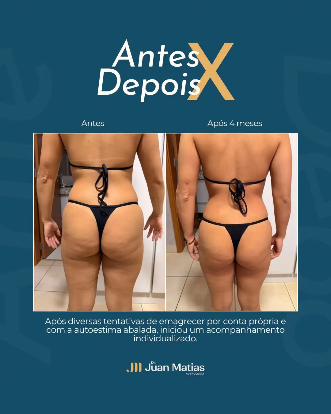 Antes e depois de emagrecimento feminino com resultado após 4 meses de acompanhamento em Brasília