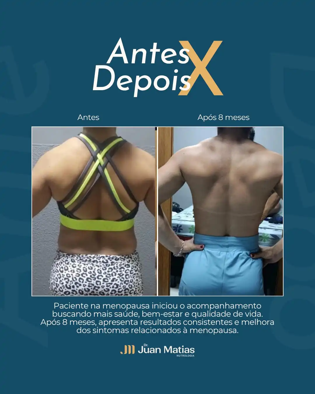 Antes e depois de melhora da composição corporal na menopausa após 8 meses com Dr. Juan Matias