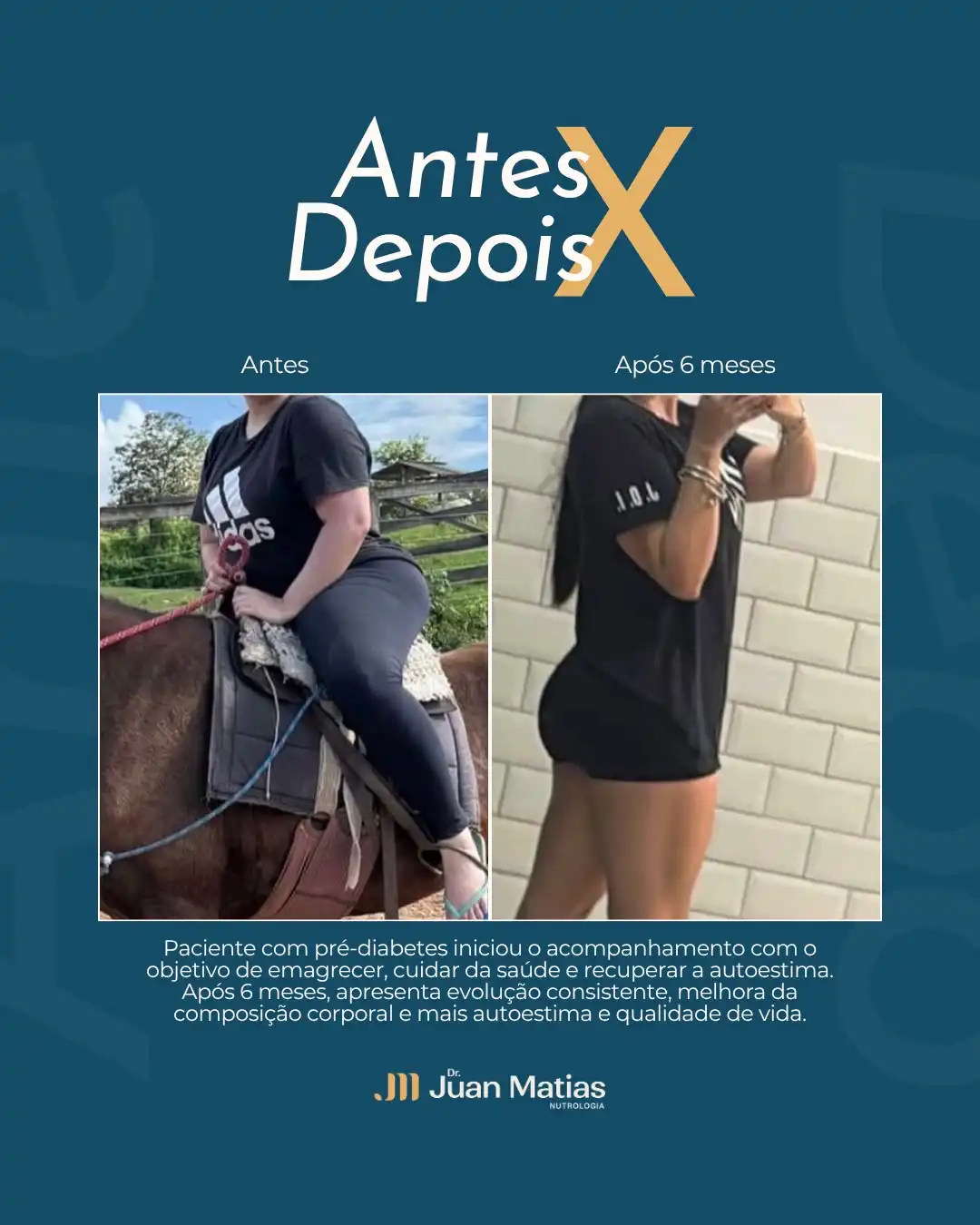 Antes e depois de paciente com pré-diabetes após 6 meses de acompanhamento nutrológico com Dr. Juan Matias em Brasília