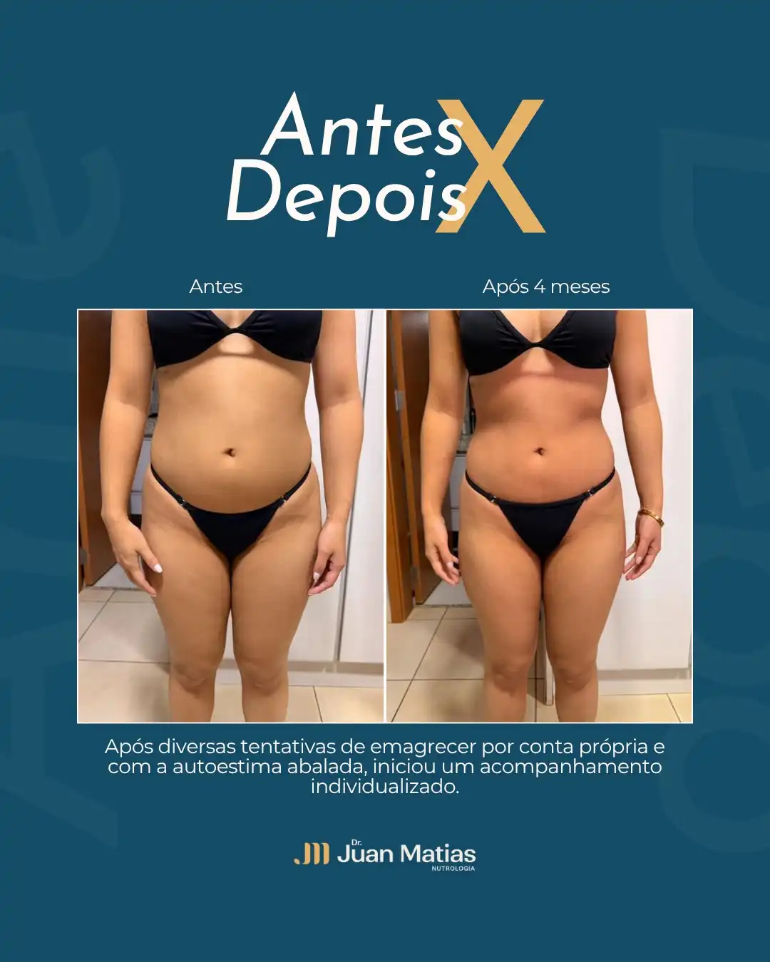 Antes e depois de emagrecimento feminino e melhora da autoestima após 4 meses de nutrologia em Brasília