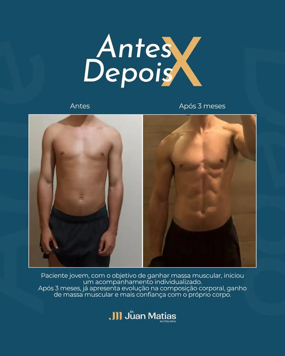 Antes e depois de ganho de massa muscular em paciente jovem após 3 meses de nutrologia em Brasília